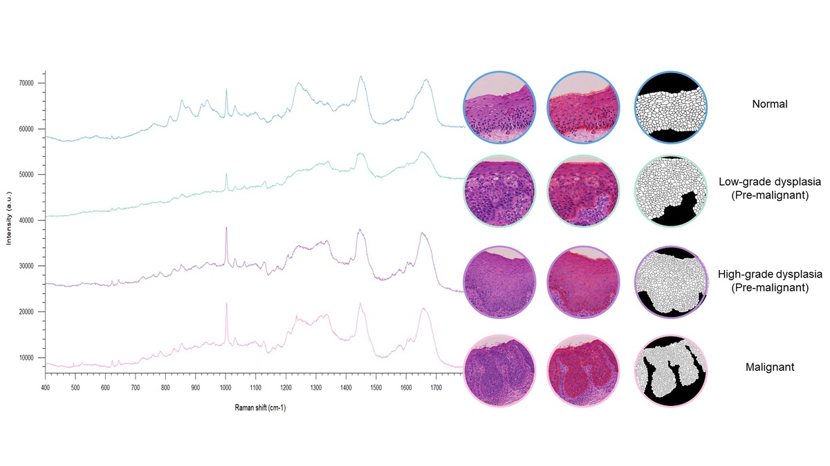 We used Raman spectroscopy on histopathological tissue sections from the oral cavity to identify biochemical differences between normal, low grade dysplasia (LGD), high grade dysplasia (HGD) and squamous cell carcinoma (SCC). The left panel shows example Raman spectra. We also used microscopy images to discern morphological differences between automatically detected cells from the different diagno