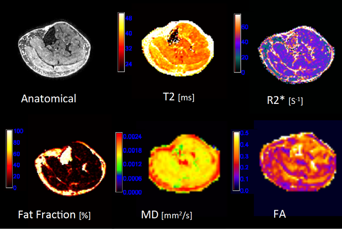 MRI