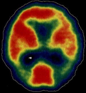 regional cerebral blood flow