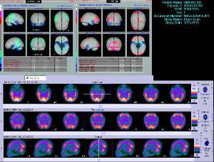 regional cerebral blood flow single photon emission computed tomography (rCBF SPECT) showing typical temporoparietal perfusion deficits in Alzheimer's disease