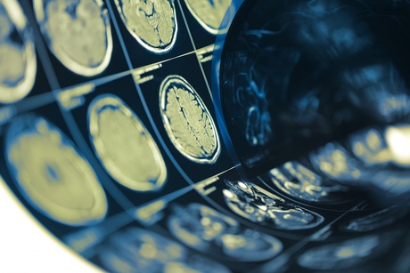 Image of a sheet of  numerous brain scans placed on a light box