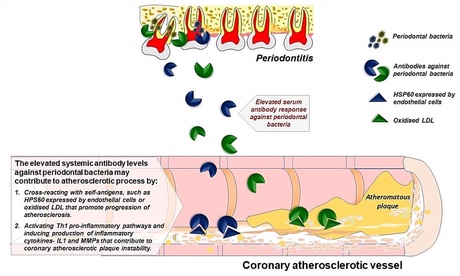 Serum antibody response against periodontal bacteria and risk of coronary heart disease