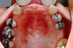 Oral candidosis