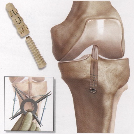 ACL rupture