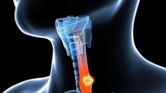 Drug aimed at treating advanced oesophageal - or gullet - cancer could lead to a new treatment approach for a sub-group of patients