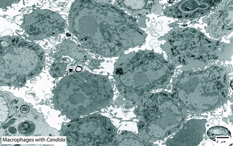 Macrophages with candida yeast infection