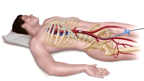 An illustration of how the REBOA technique is administered