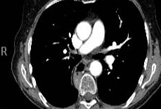 Scan showing Cancer remains controlled for 18 months on gefitinib treatment before re-growth in the chest wall