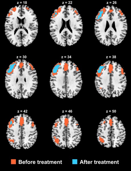 Functional connectivity in severely depressed patients before (displayed in orange) and after ECT treatment (displayed in cyan), showing a substantial reduction in the brain’s functional connectivity after treatment.