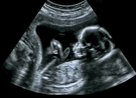 ultrasound foetal scan