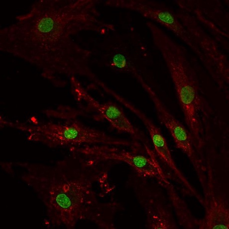 Stem cells of an oteoarthritis patient