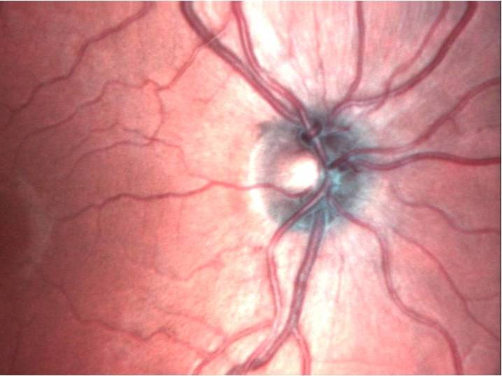 Laser scanning ophthalmoscope image of the retina