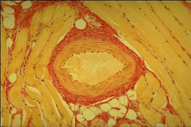 Neutrophils - 3