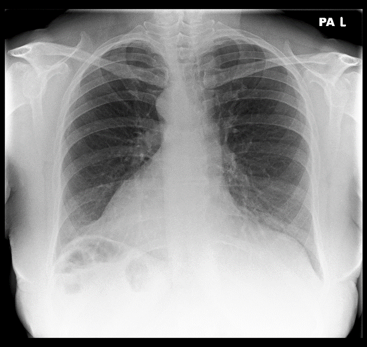 Chest X-ray