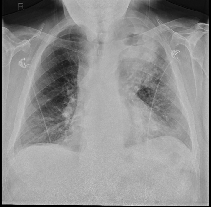 Chest X-ray