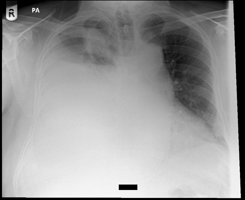 Chest X-ray