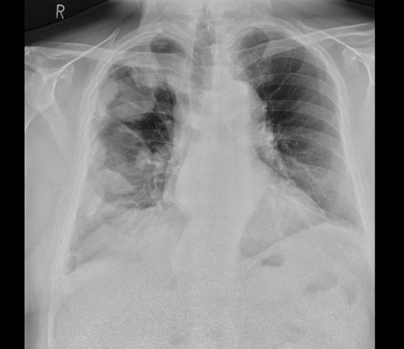 Chest X-ray