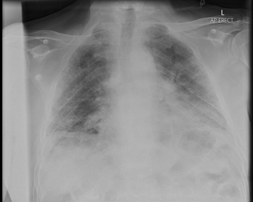 Chest X-ray