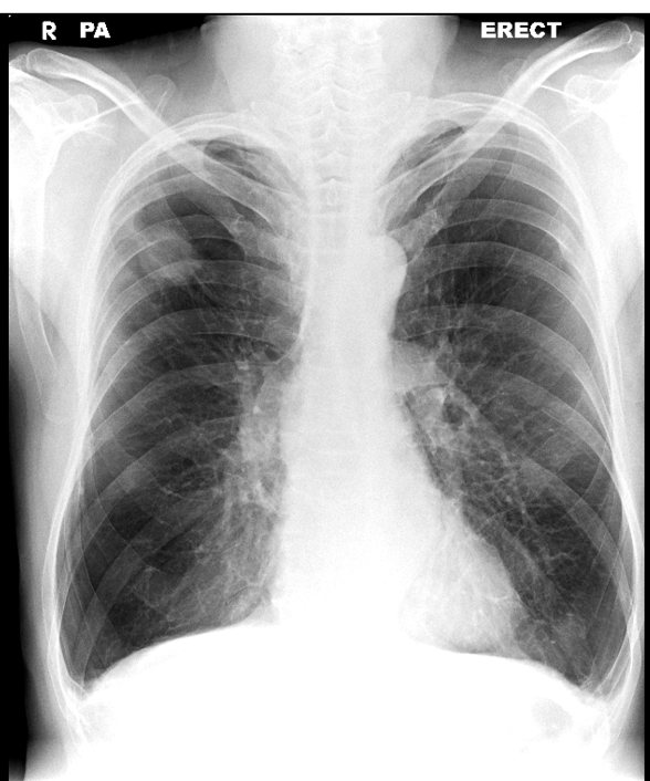 Chest X-ray