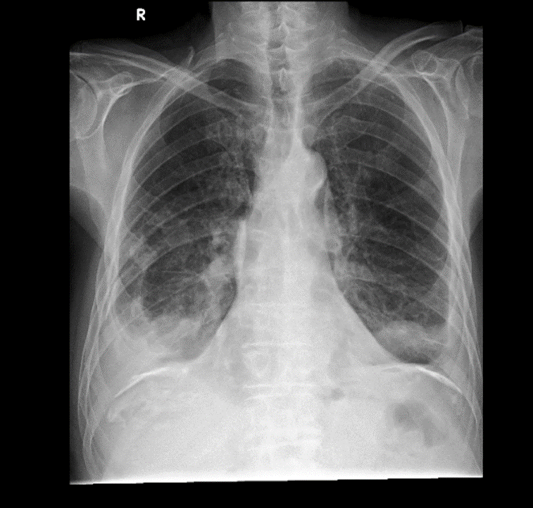 Chest X-ray