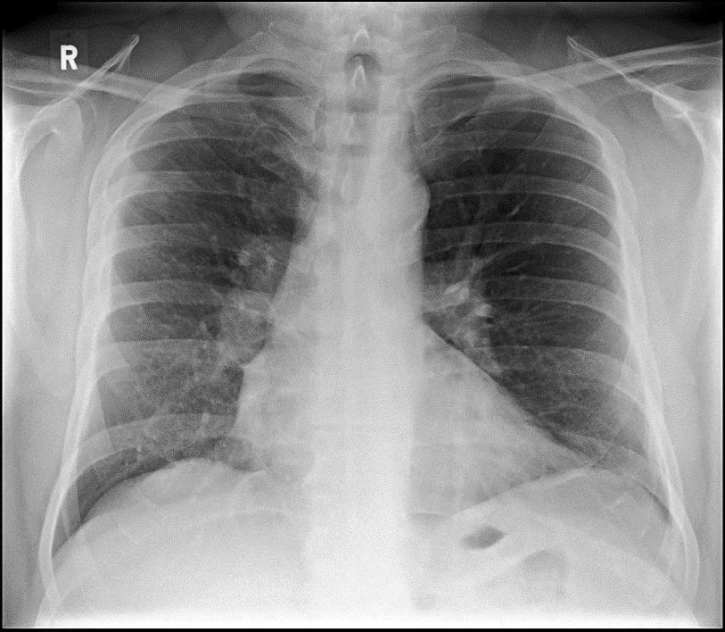 Chest X-ray