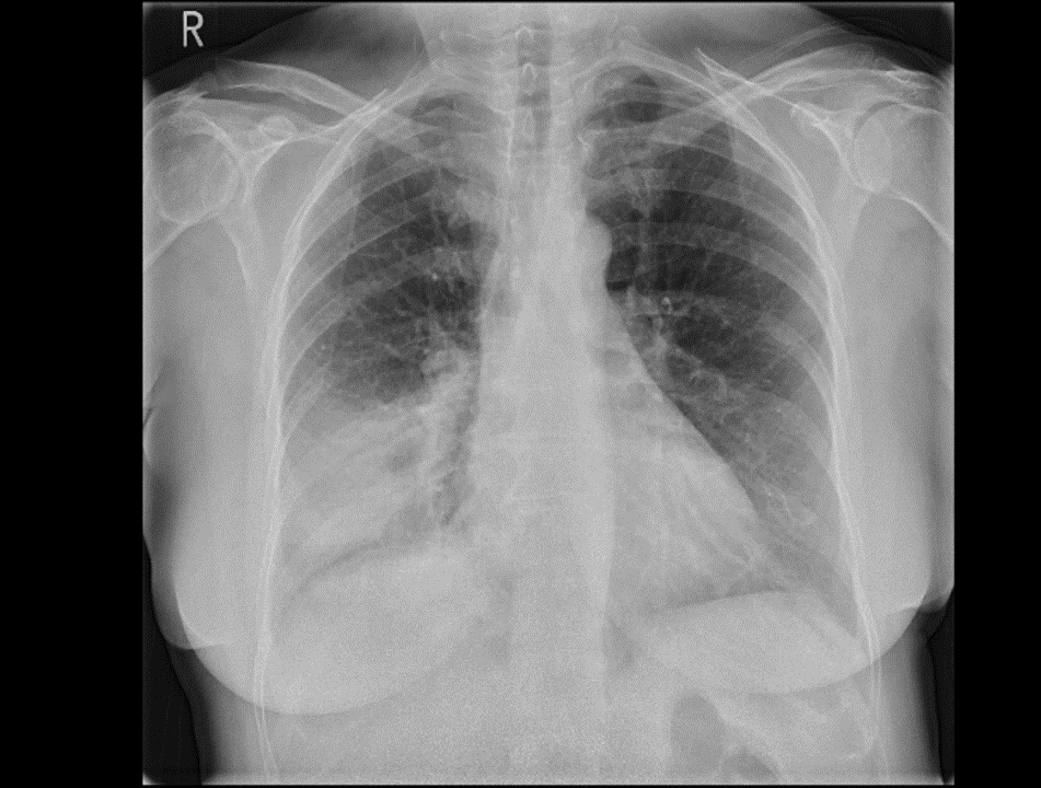 Chest X-ray