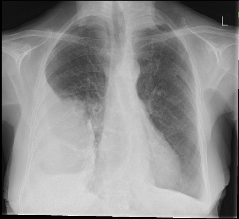 Chest X-ray