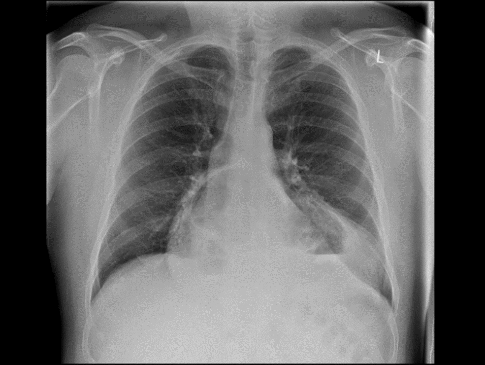 Chest X-ray