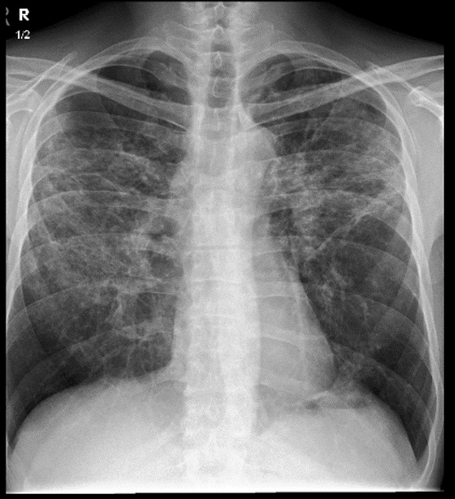 Chest X-ray