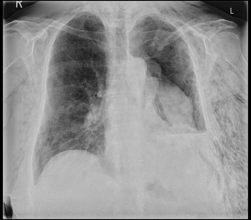 Chest X-ray