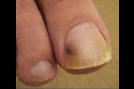 Brown mark under big toe nail, with radiating borders