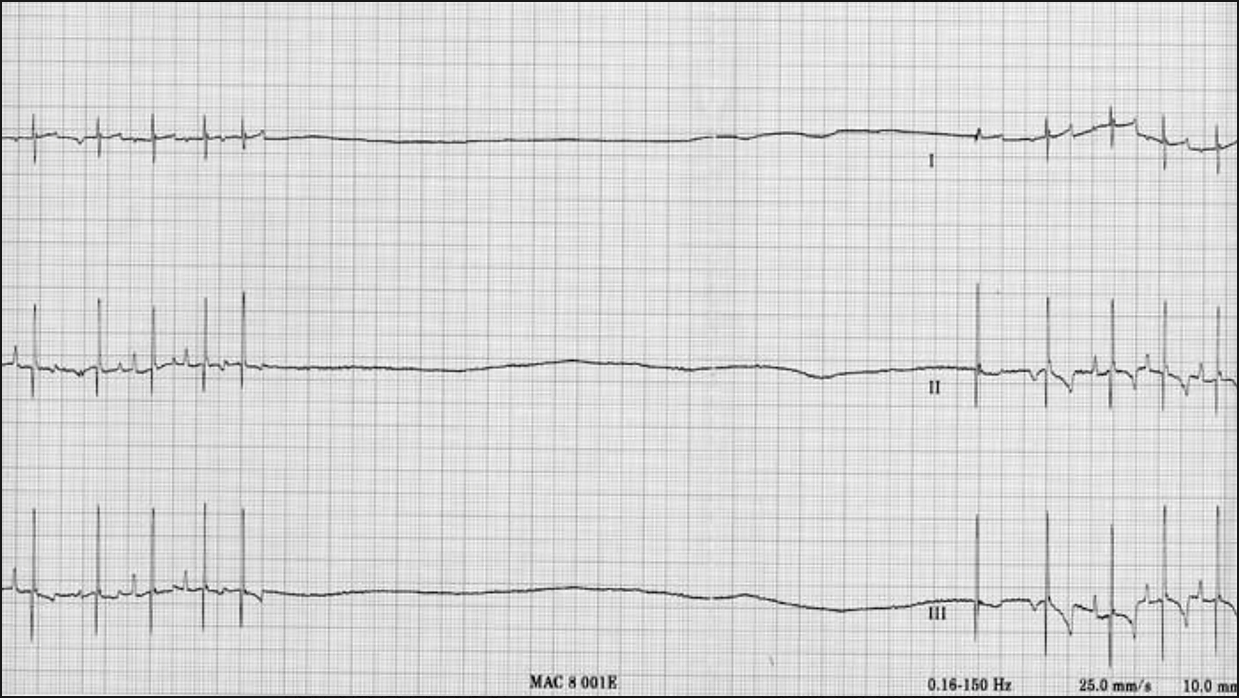 Asystole Trace