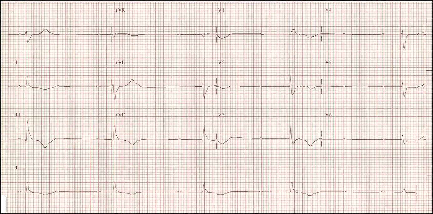 QRS and P-Waves Don't Match Up