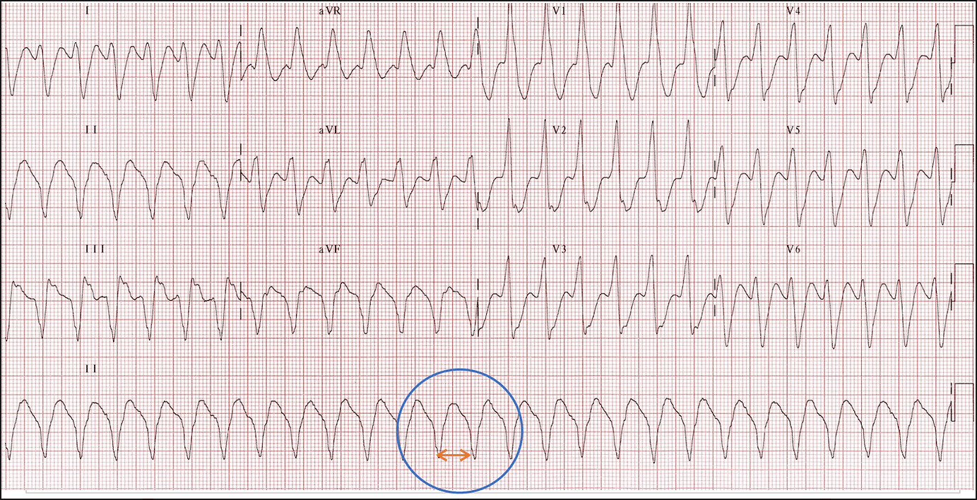 normal qrs
