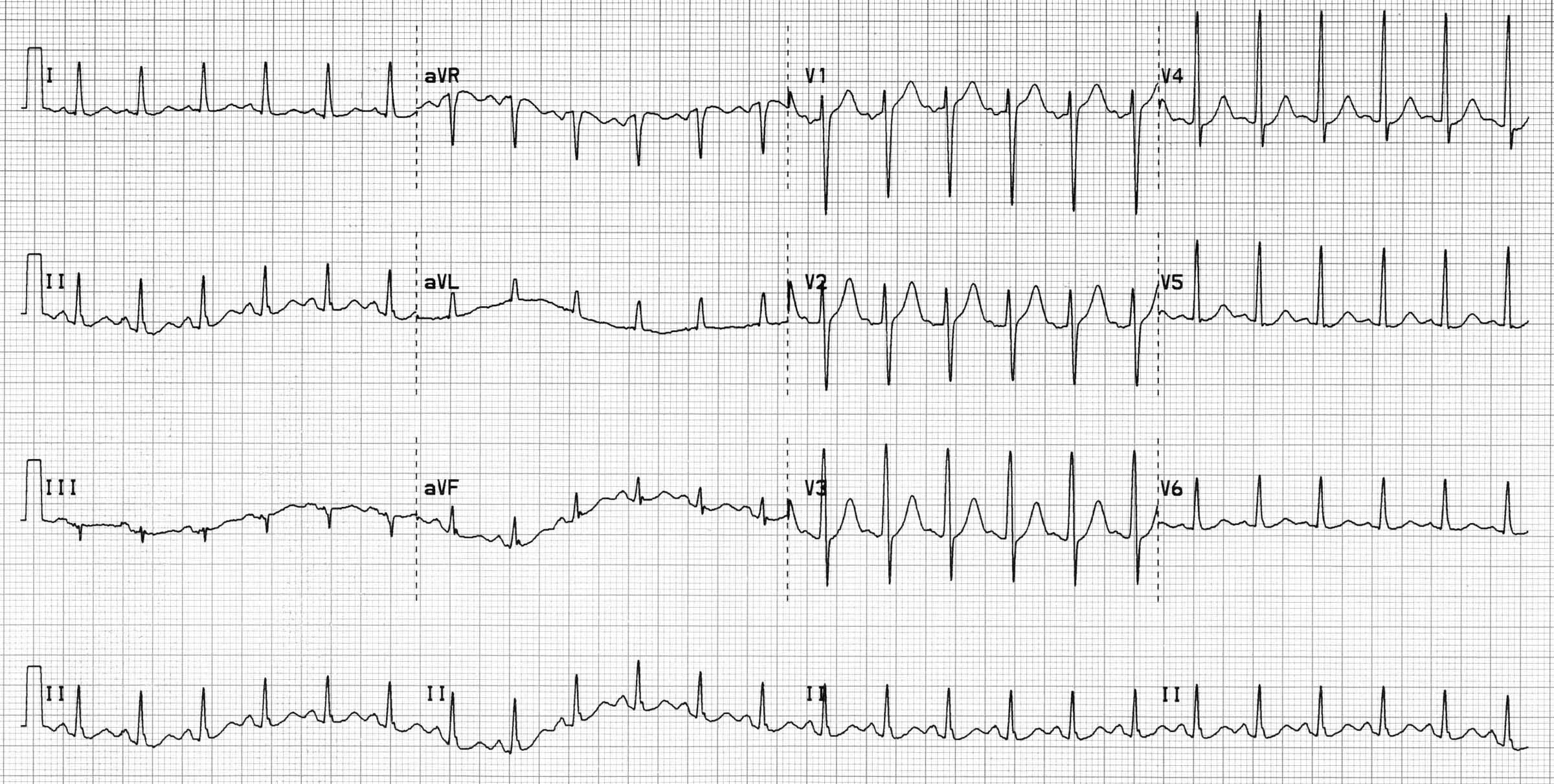 What does the ECG show?