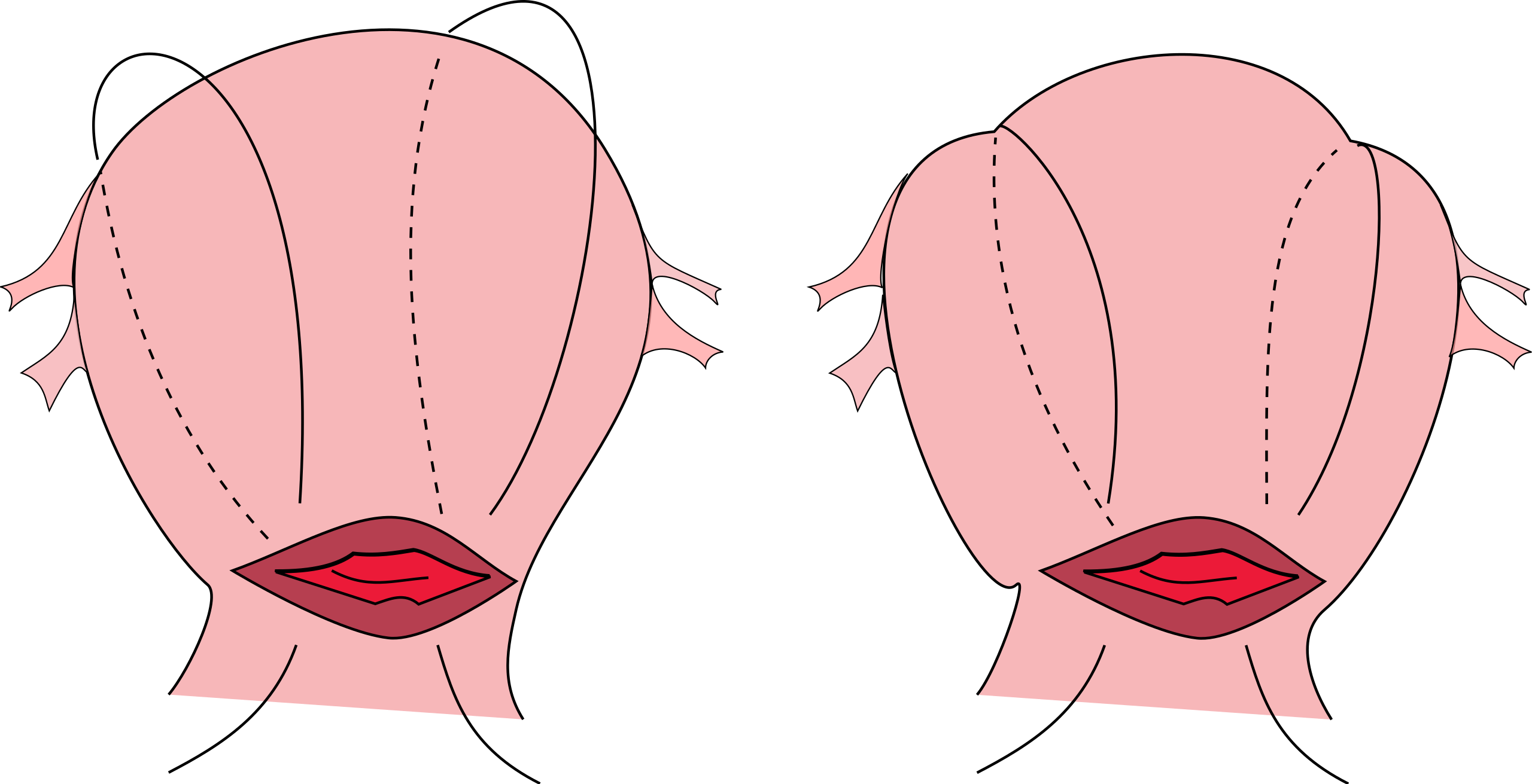 B Lynch suture