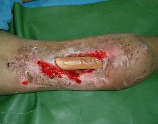 photograph showing contaminated wound