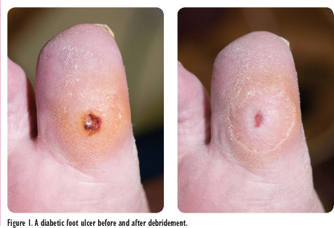 diabetic foot ulcer before and after