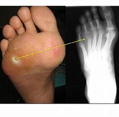 comparison showing x-ray and photo of wound/lesion at site of OM