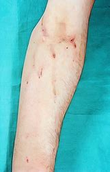 photo of skin showing symtoms