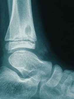 x-ray of ankle