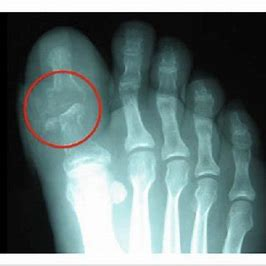 x-ray of toes