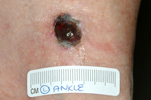nodule skin lesion
