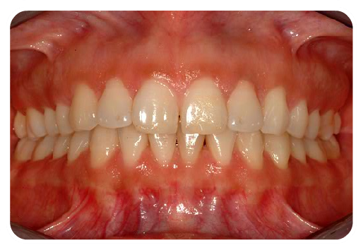 Anterior Occlusion