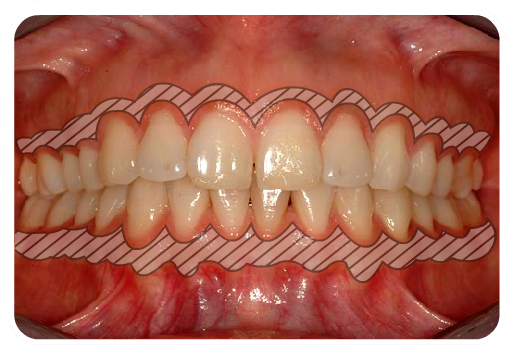 Anterior Occlusion