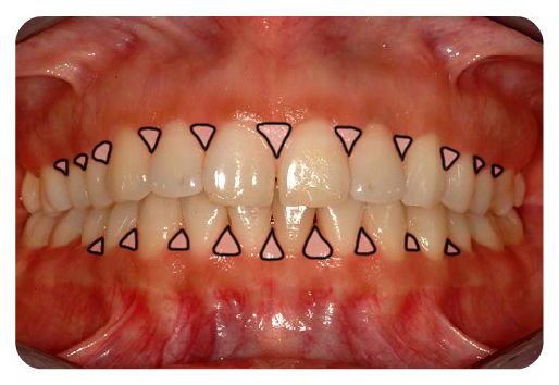 Anterior Occlusion