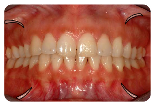 Anterior Occlusion