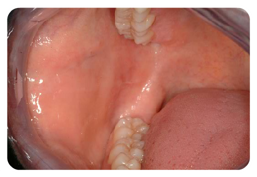 Buccal Mucosa