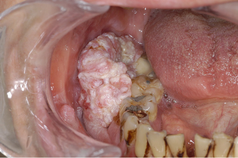 buccal sulcus