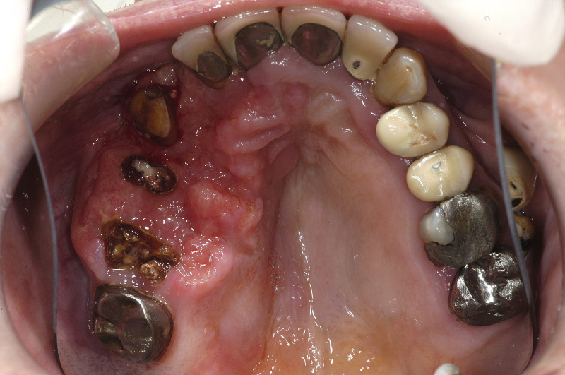 hard palate